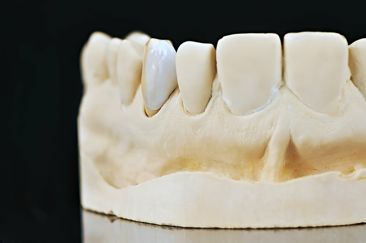 The Porcelain Veneer Process: What to Expect at Hoosier Family Dentistry_FI